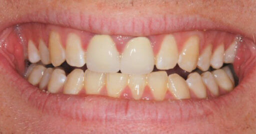 patient teeth 2 before